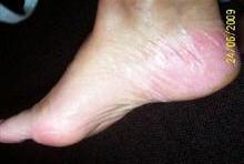 foot psoriasis after